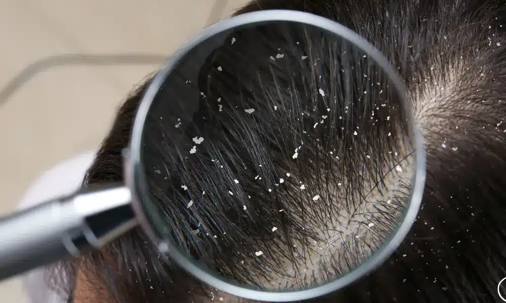 dandruff in hair